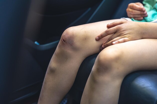 Closeup of little girl holding her bruised injured damaged knee with her hands