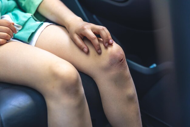 Closeup of little girl holding her bruised injured damaged knee with her hands