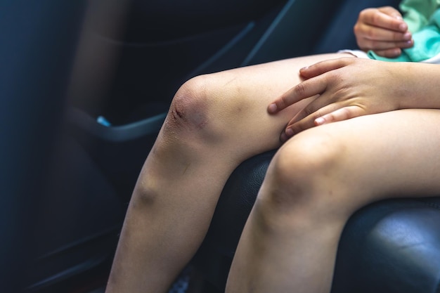 Бесплатное фото Крупный план маленькой девочки, держащей руками ушибленное поврежденное колено