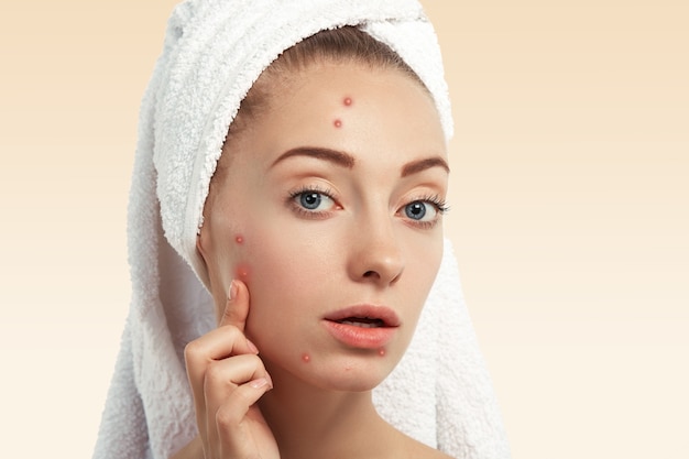 Closeup of young woman with towel on head and pimples on face