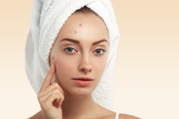 Closeup of young woman with towel on head and pimples on face