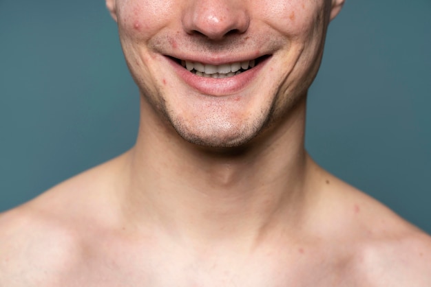 Free photo confident handsome man with acne