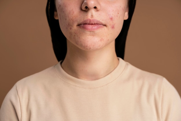 Confident young woman with acne close-up