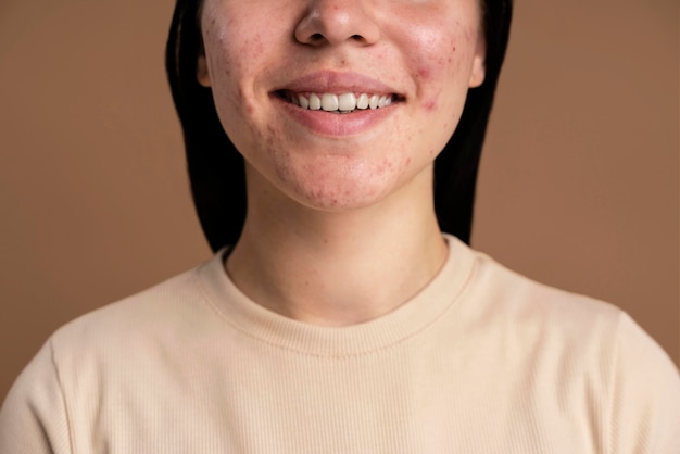 Free photo confident young woman with acne close-up