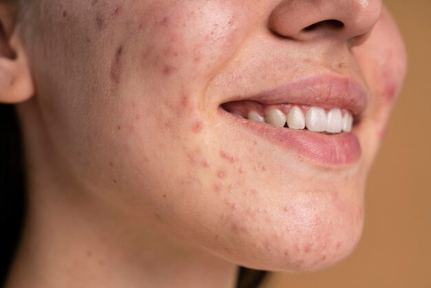 Confident young woman with acne close-up