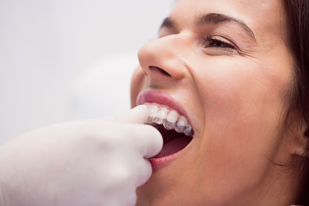 여성 환자가 교정기를 착용하도록 돕는 치과 의사
