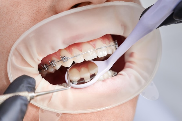 환자 치아에 금속 교정기를 부착하는 치과 의사
