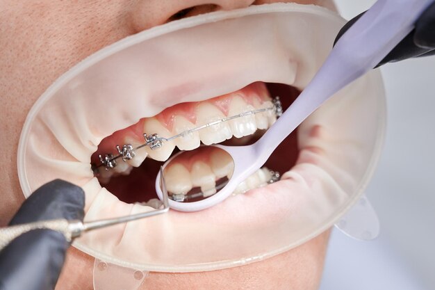 Dentist attaching metal braces to patient teeth