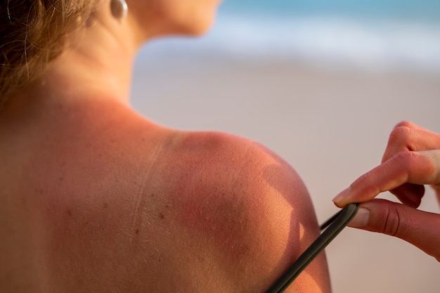 Details of a woman's sunburn skin from the beach sun