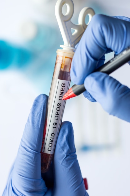 Doctor's lab technician's hand, holding the tube with blood