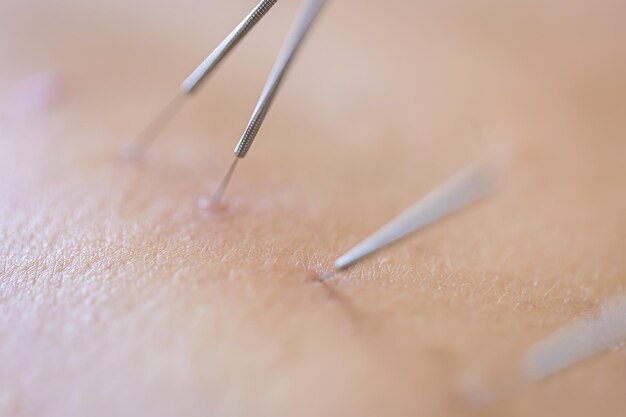 患者の乾燥した鍼治療の針をクローズ アップ