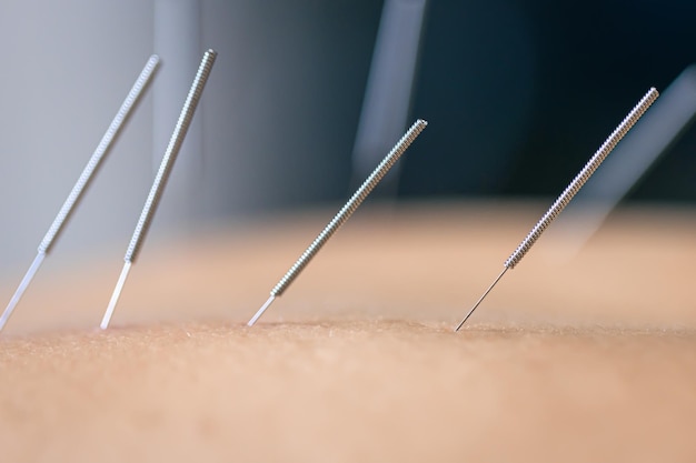 Free photo dry needling acupuncture needles on patient close up