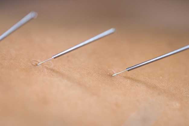 Free Photo dry needling acupuncture needles on patient close up
