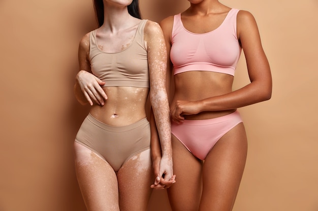Every body is beautiful. two women of different race and skin conditions dressed in lingerie