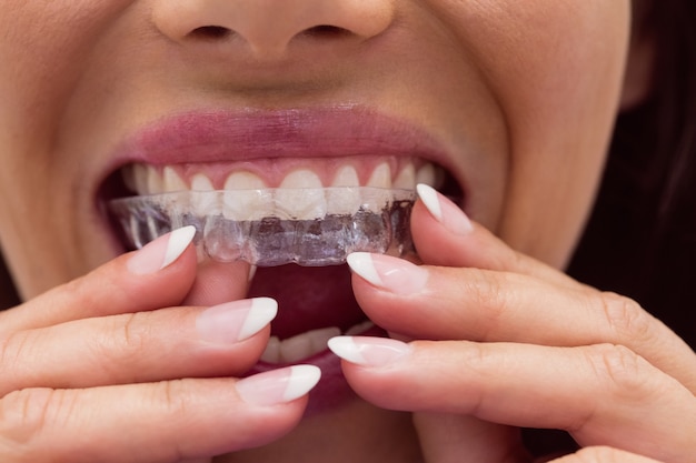 Female patient wearing braces