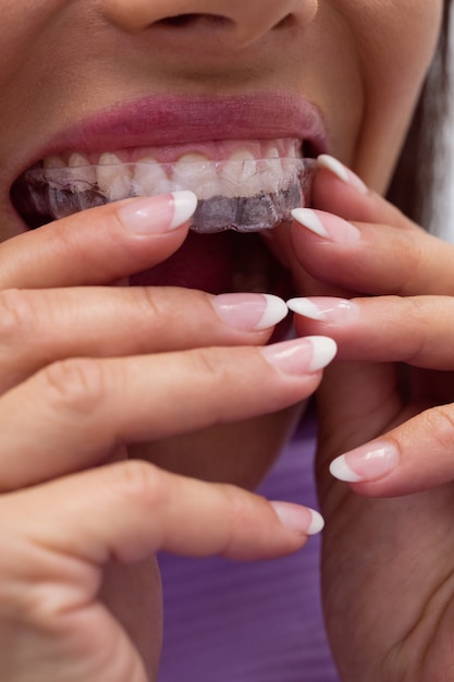 Female patient wearing braces