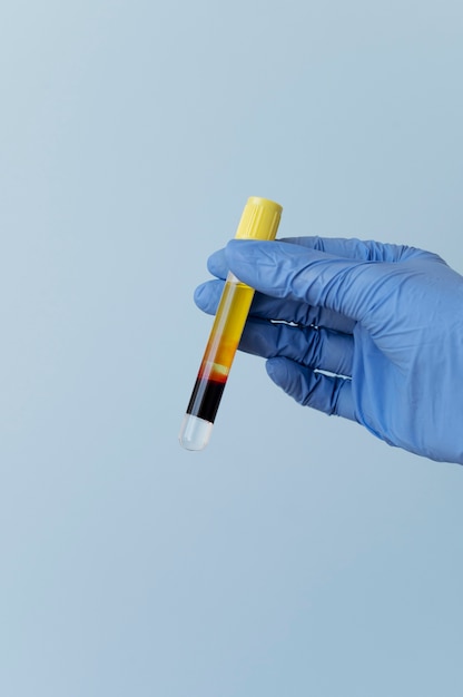 Free photo hand with glove holding vial for prp treatment