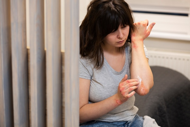 Бесплатное фото Руки пациента, страдающего псориазом