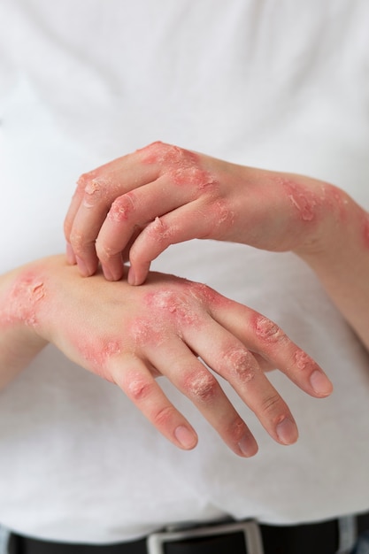 Free photo hands of patient suffering from psoriasis