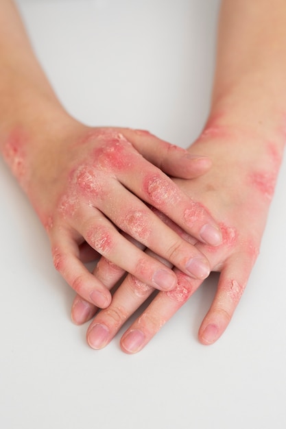 Foto gratuita mani di pazienti affetti da psoriasi