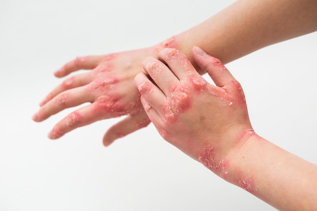 Free photo hands of patient suffering from psoriasis