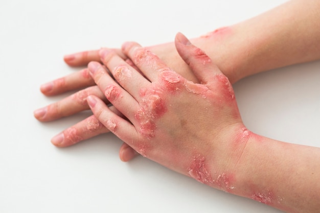 Hands of patient suffering from psoriasis