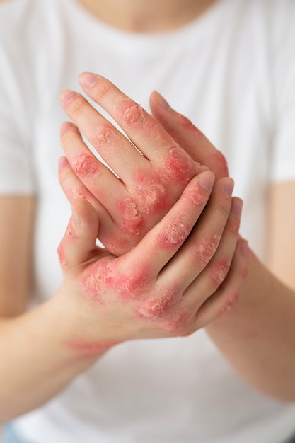 Free photo hands of patient suffering from psoriasis