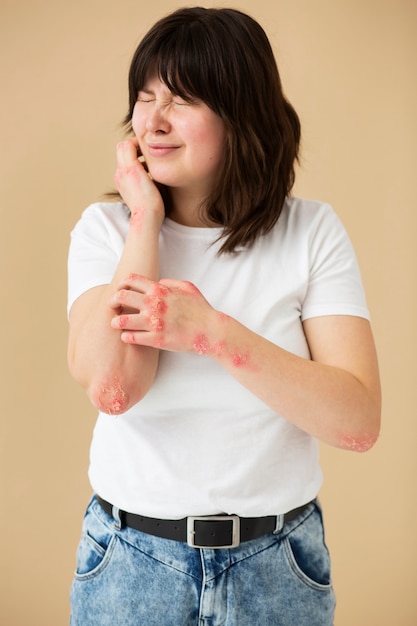 Free photo hands of patient suffering from psoriasis