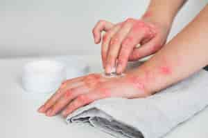 Free photo hands of patient suffering from psoriasis