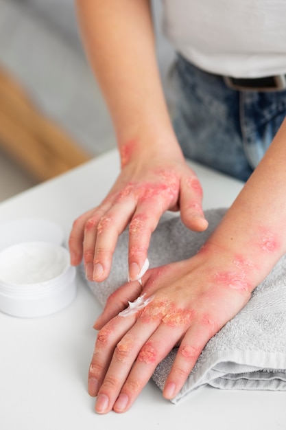 Free photo hands of patient suffering from psoriasis