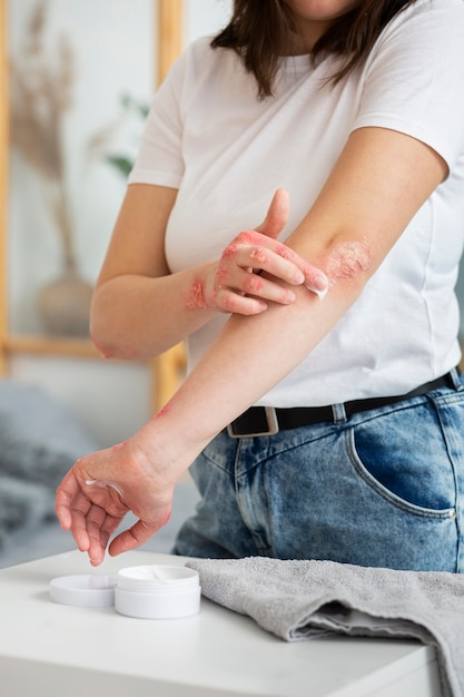 Free photo hands of patient suffering from psoriasis