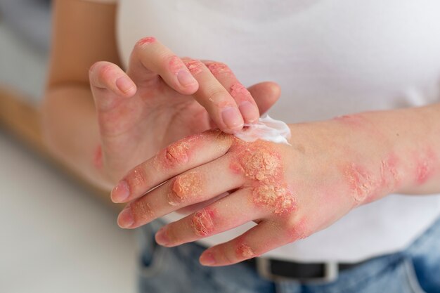 Hands of patient suffering from psoriasis