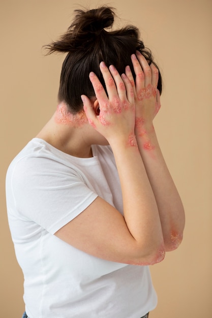 Hands of patient suffering from psoriasis