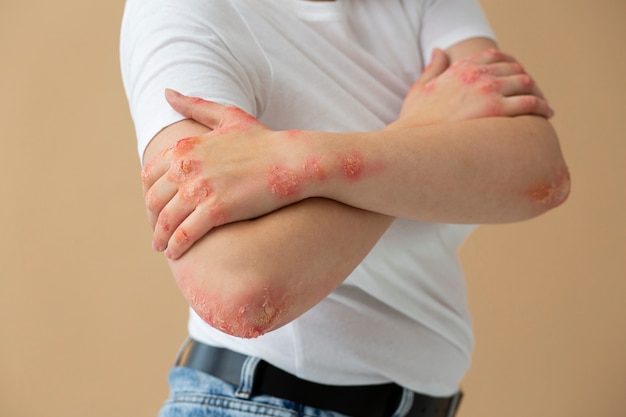 Free photo hands of patient suffering from psoriasis