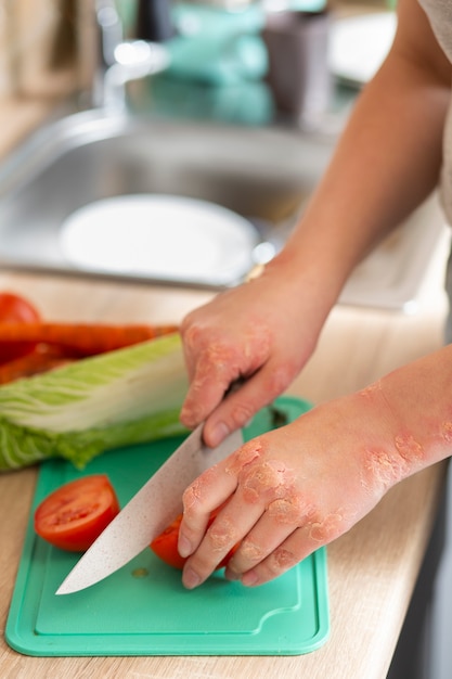 Hands of patient suffering from psoriasis