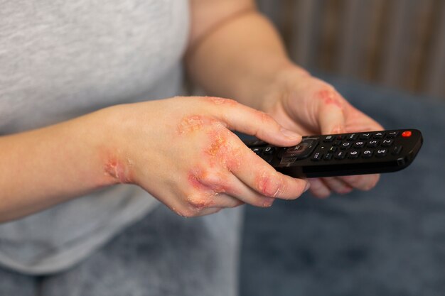 Hands of patient suffering from psoriasis