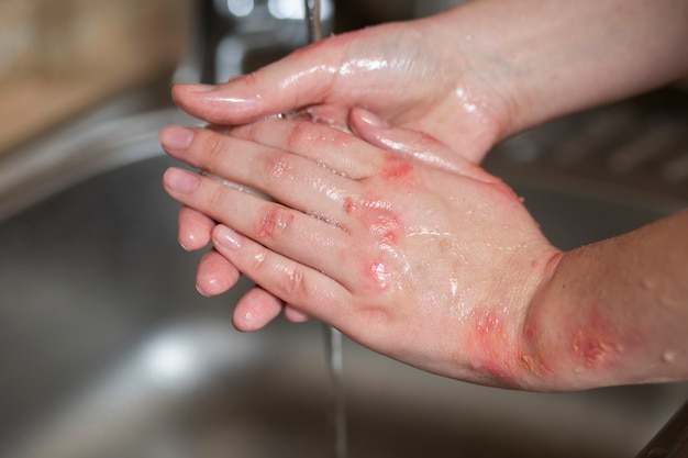 Free photo hands of patient suffering from psoriasis