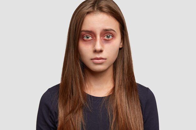 Headshot of attractive brunette woman with bruises around eyes, looks with miserable expression directly at camera