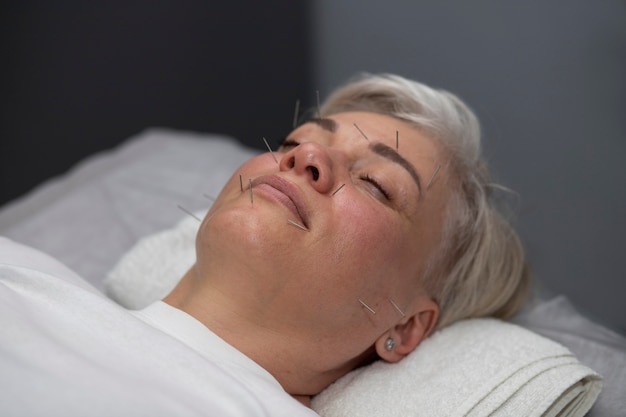 Free photo high angle smiley woman acupuncture treatment