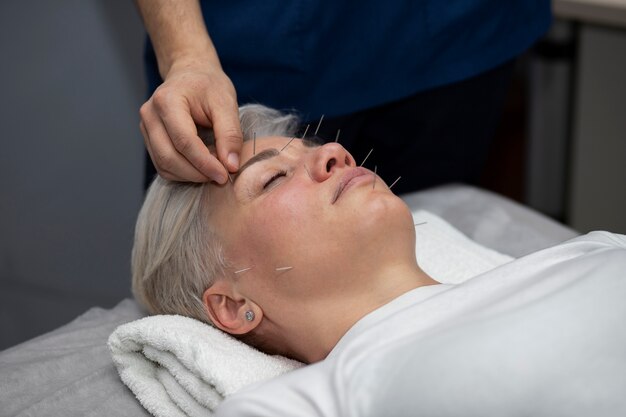 high angle woman acupuncture treatment