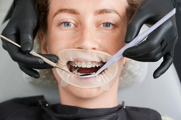 Macro photography of beautiful girl with braces in dental clinic