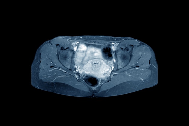 Magnetic resonance imaging pelvic of a healthy woman finding abnormalities like mass lumps.medical healthcare concept.