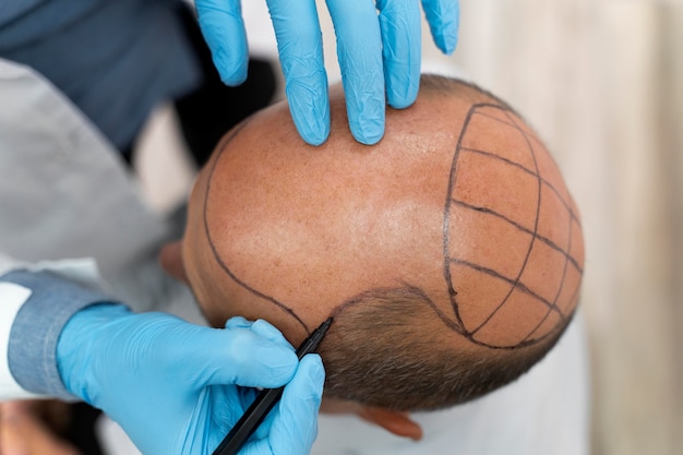 Male going through a follicular unit extraction process