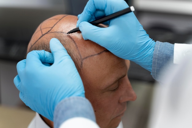 Male going through a follicular unit extraction process