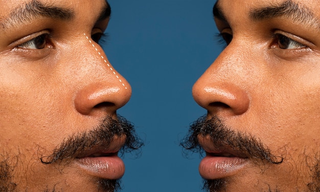鼻形成術の前後の男性の側面図
