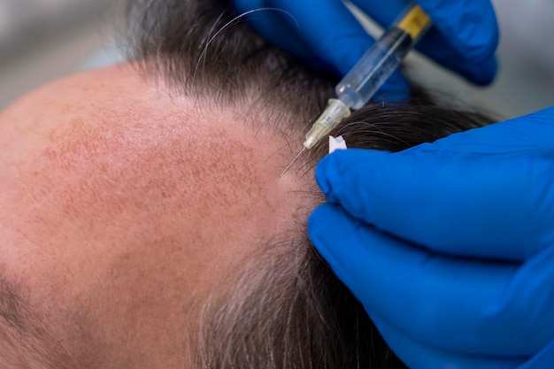 Uomo che si sottopone a un trattamento per la caduta dei capelli