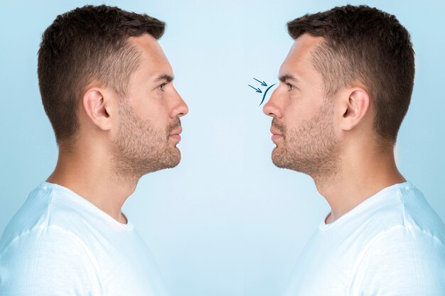 Man getting ready for nose job surgery