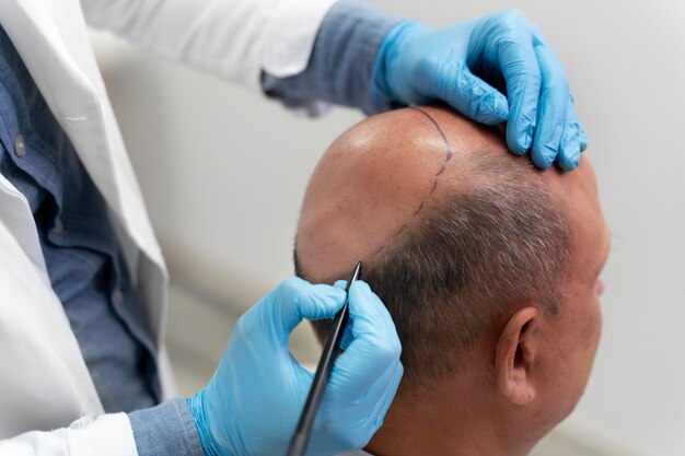 Man going through a follicular unit extraction process