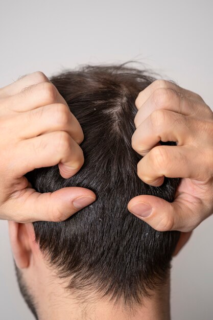 Man with dandruff issues close up