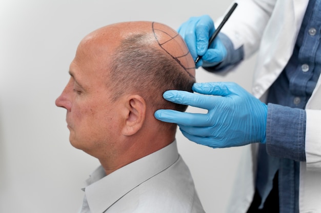 Free photo mature man going through a follicular unit extraction process